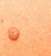 Skin-tags-warts